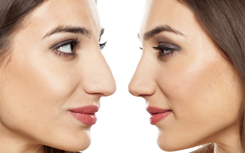 rinoplastia 1 precio Rinomodelación