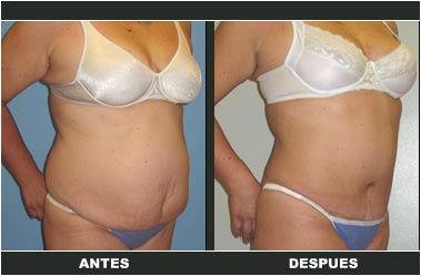 Abdominoplastia antes y después