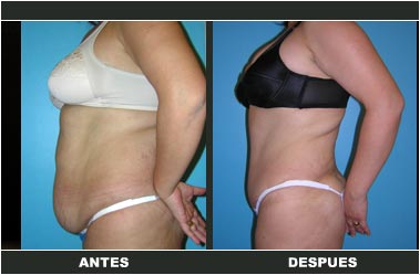 Abdominoplastia antes y después