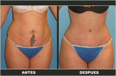 Abdominoplastia antes y después