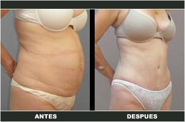 Abdominoplastia