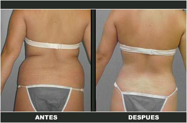 Abdominoplastia antes y después