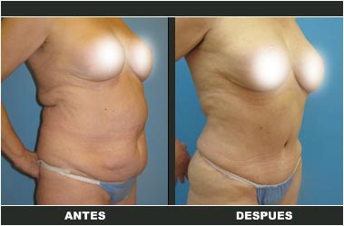 Abdominoplastia antes y después