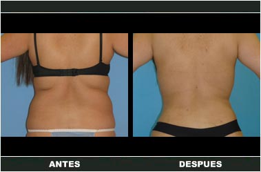 Abdominoplastia antes y después