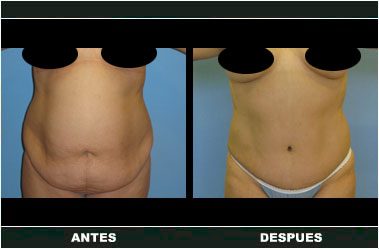 Abdominoplastia antes y después